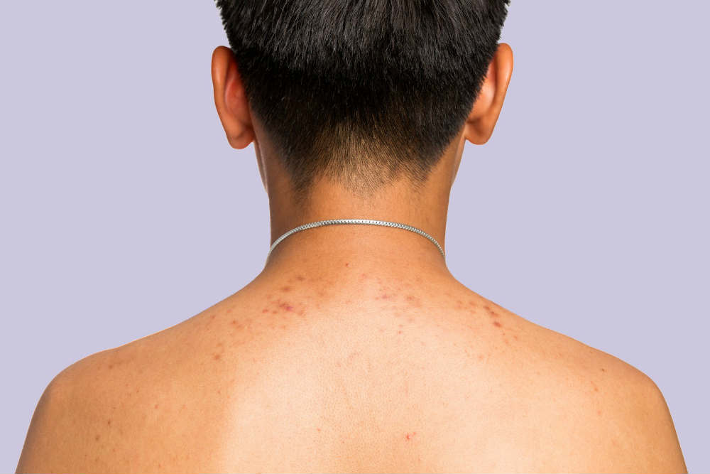 Acne on Back