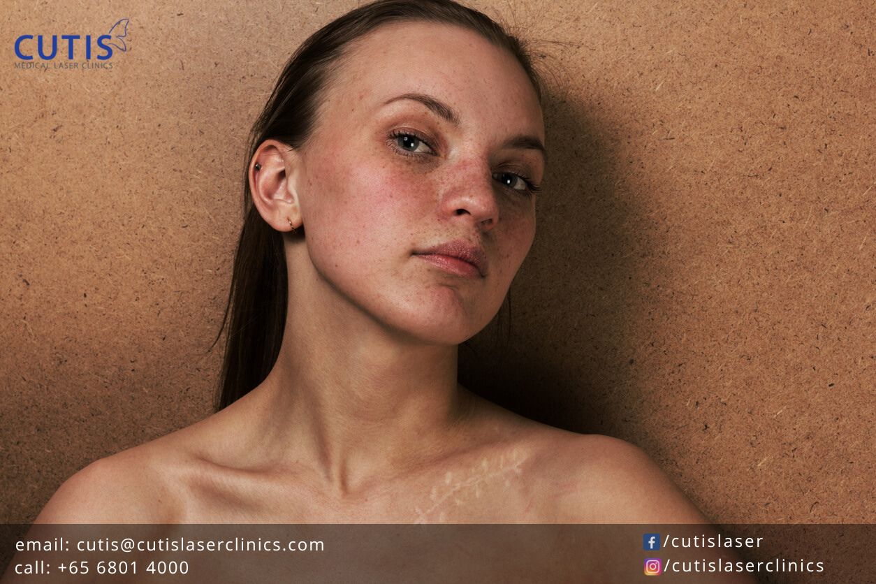 All About Scars Can You Fade or Prevent Them- Types of Scars All About Scars Can You Fade or Prevent Them- Types of Scars