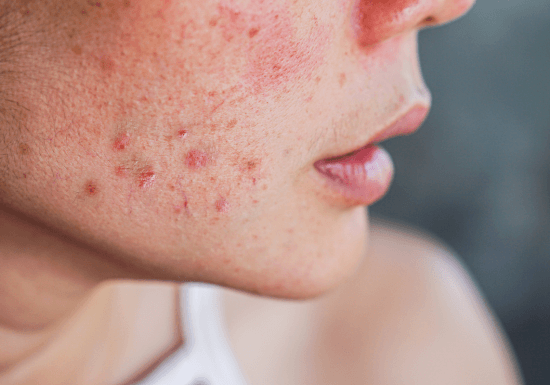 Clarifying Facial with DiamondTome and Sapphire Blue Light Therapy