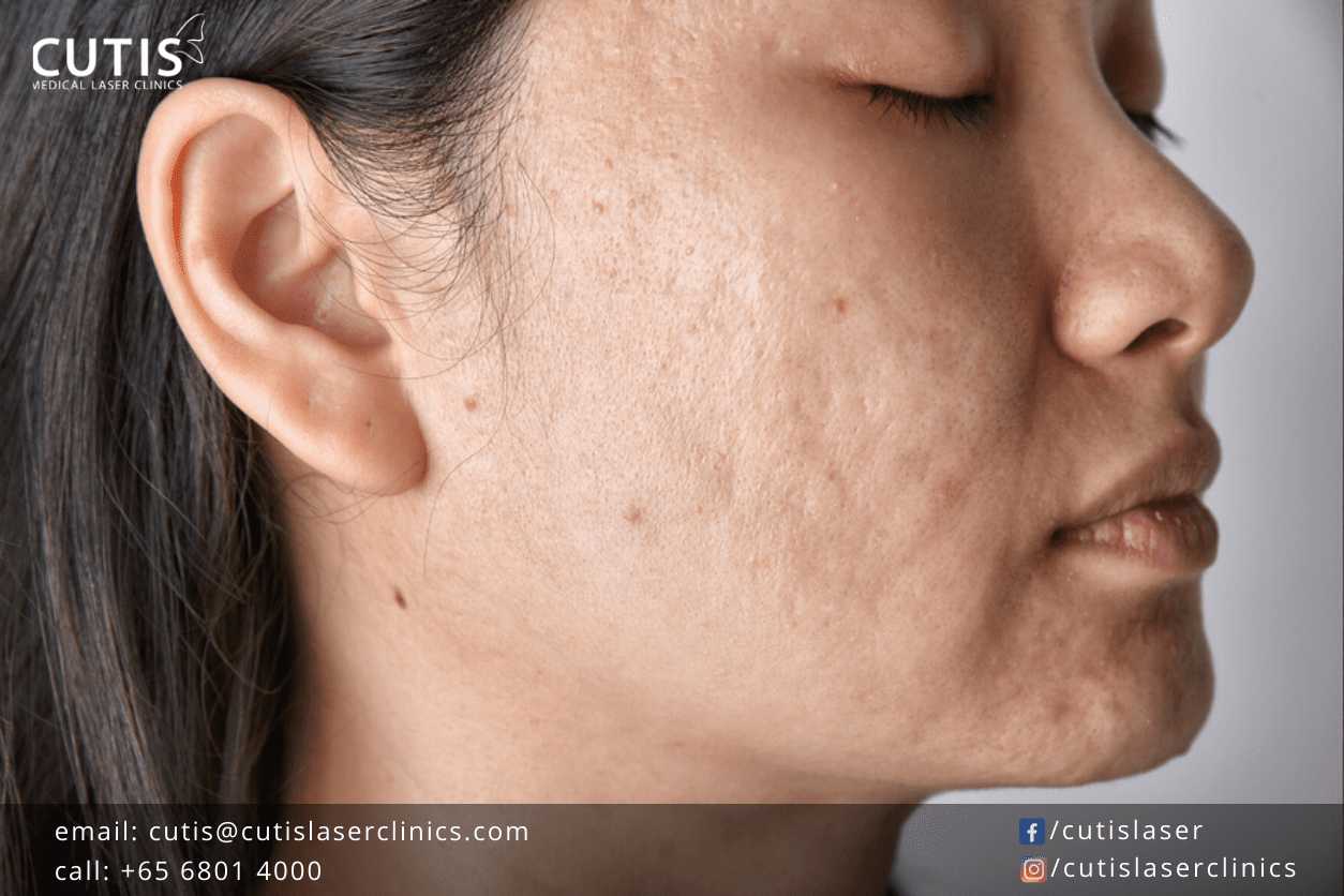 Skin Resurfacing: Transform and Rejuvenate Your Skin with a Pearl-Like Glow