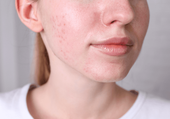 Acne and Acne Scars