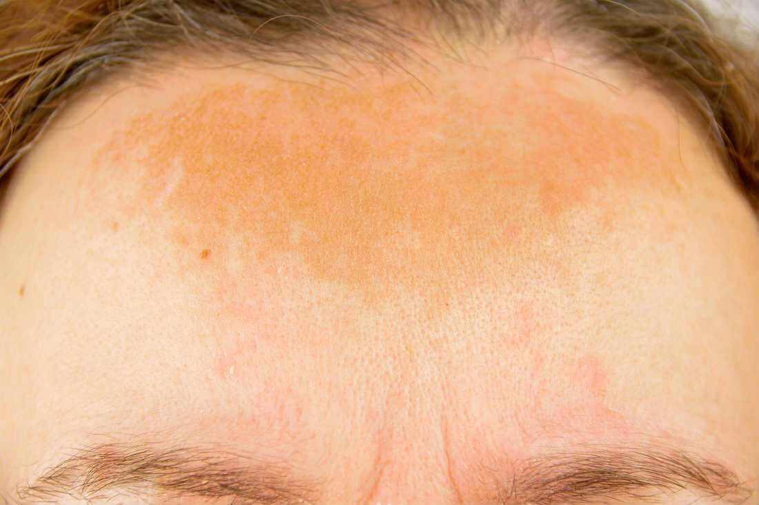 melasma-treatment