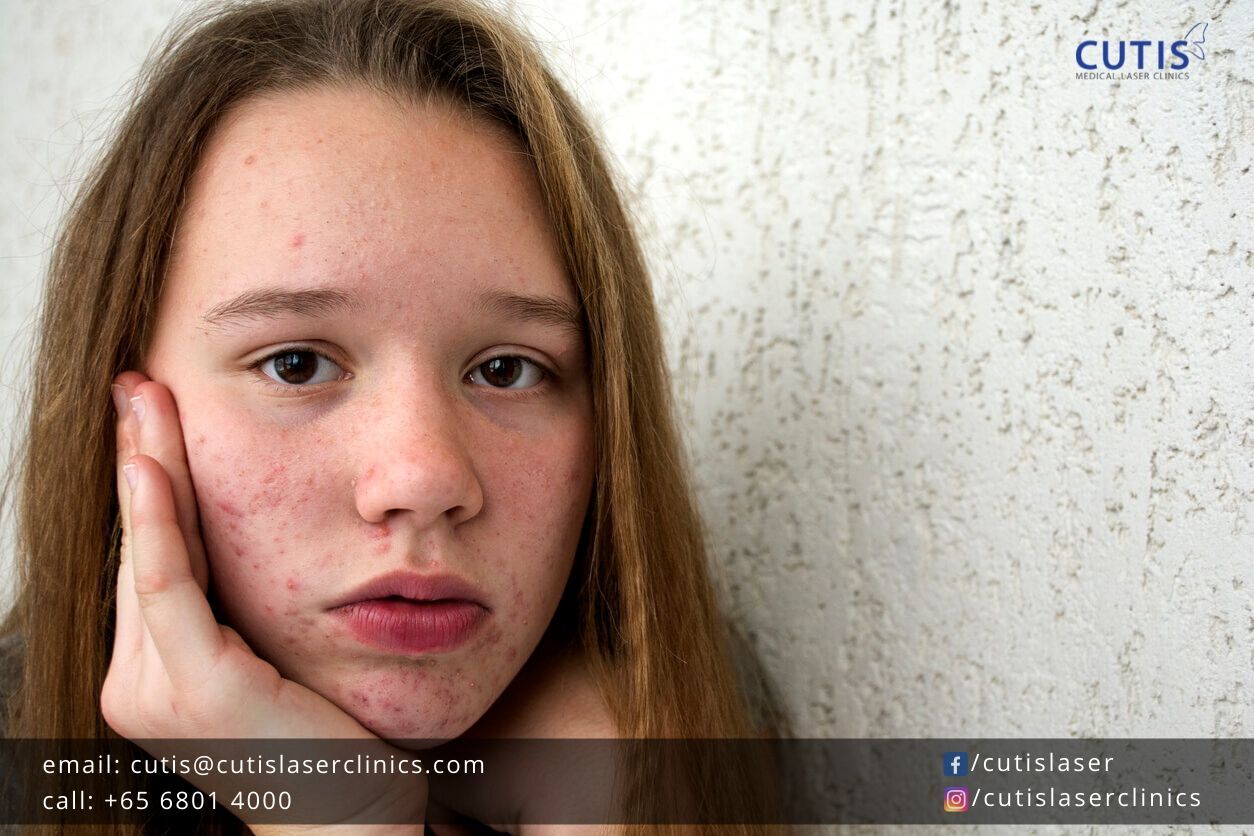 Adult-Acne-Cutis-Laser-Clinics