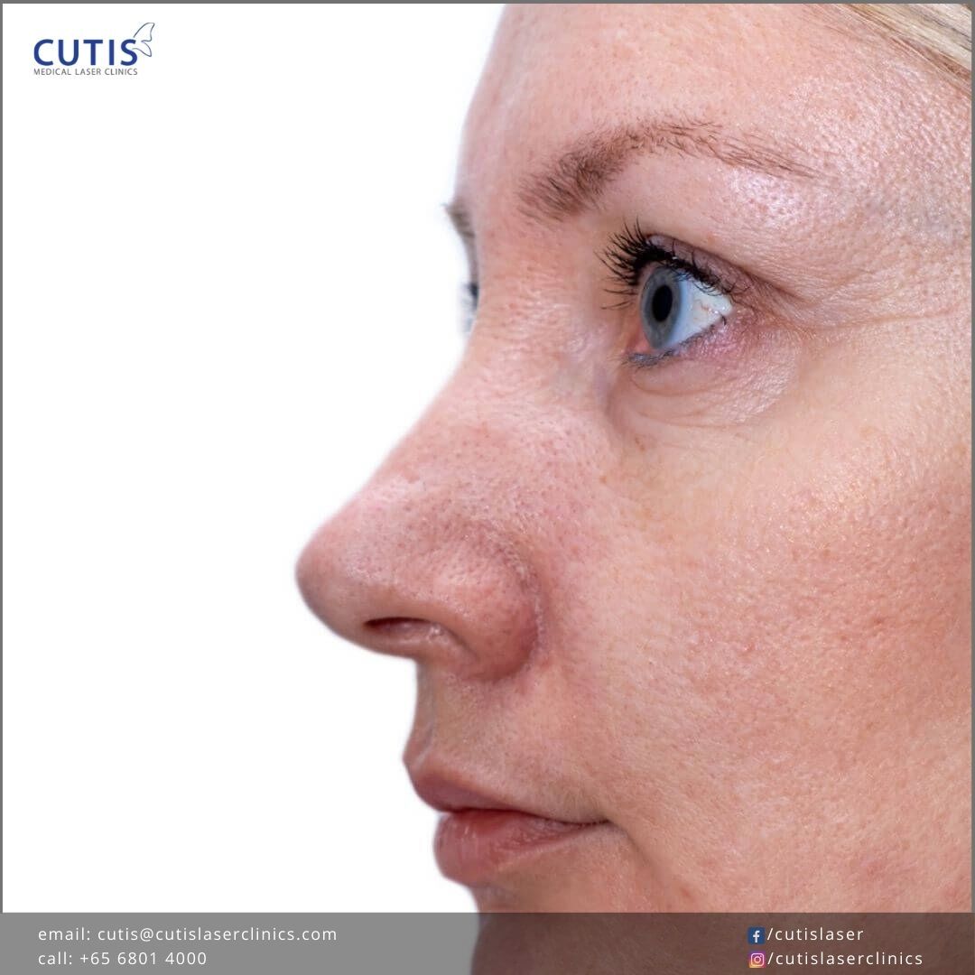 PicoCare-Laser-Treatments