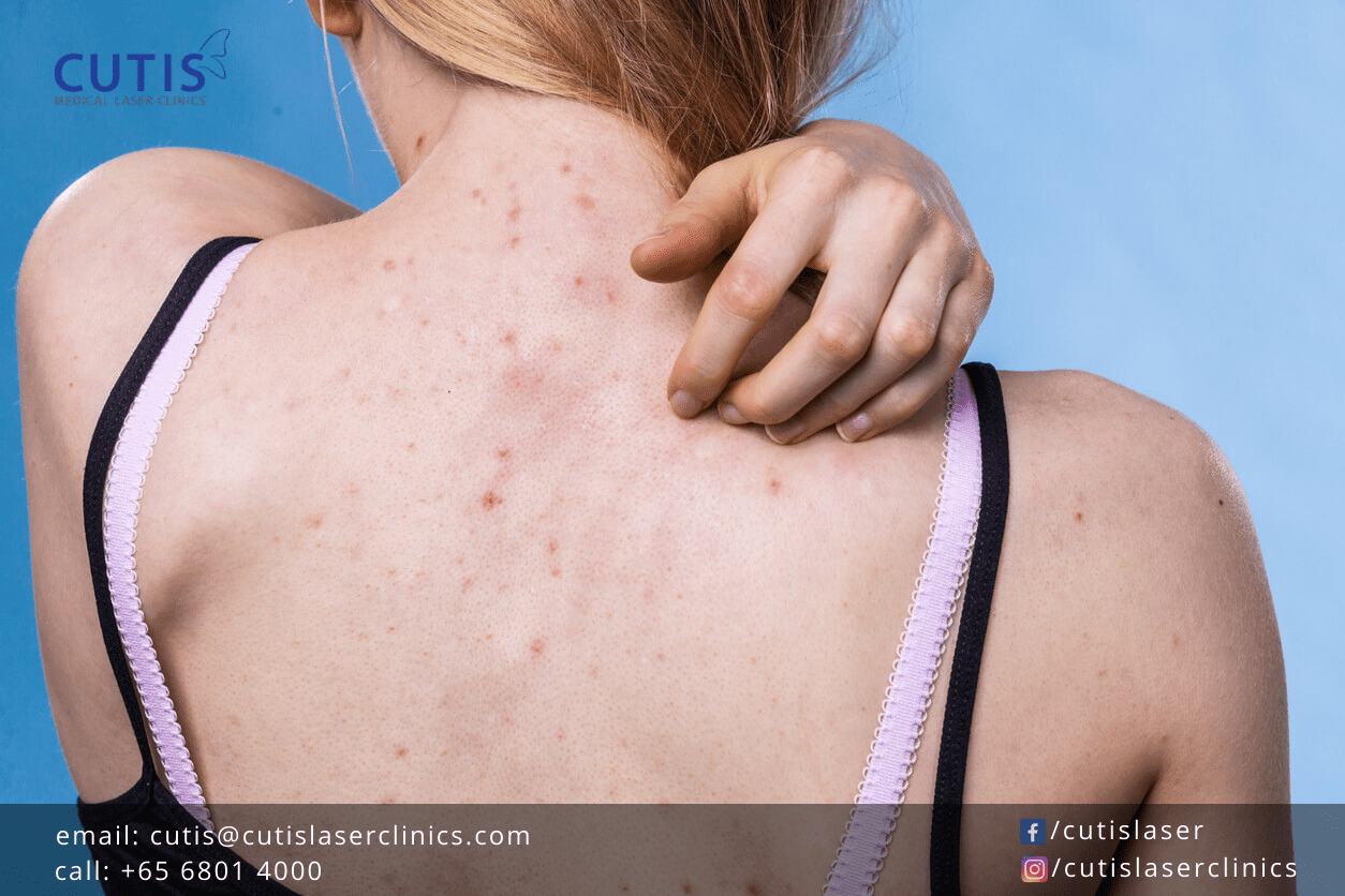 Back Acne (Bacne), Pigmentation, and Scarring What Can Help