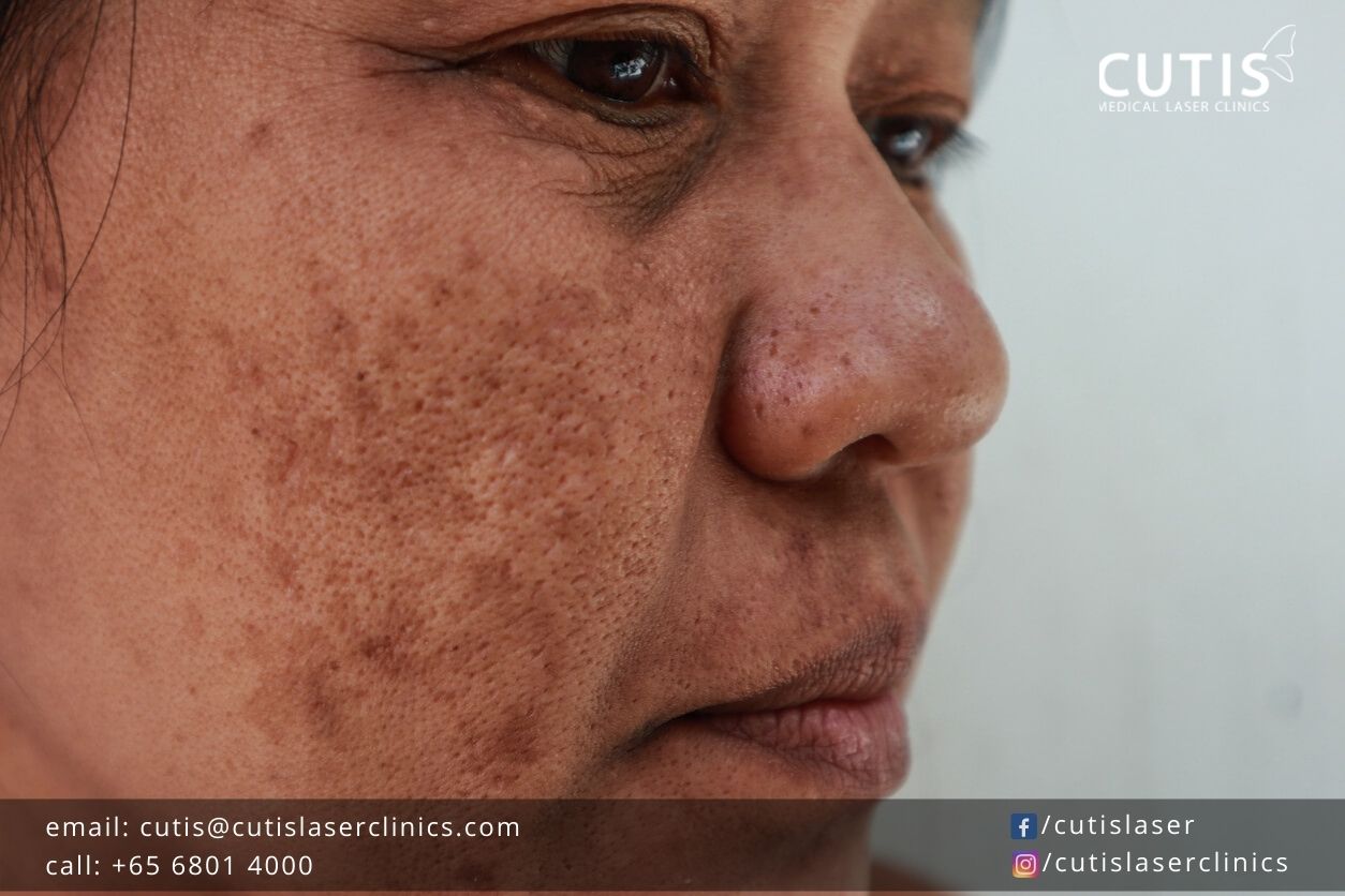 Your-Common-Questions-About-Melasma-Answered Your-Common-Questions-About-Melasma-Answered