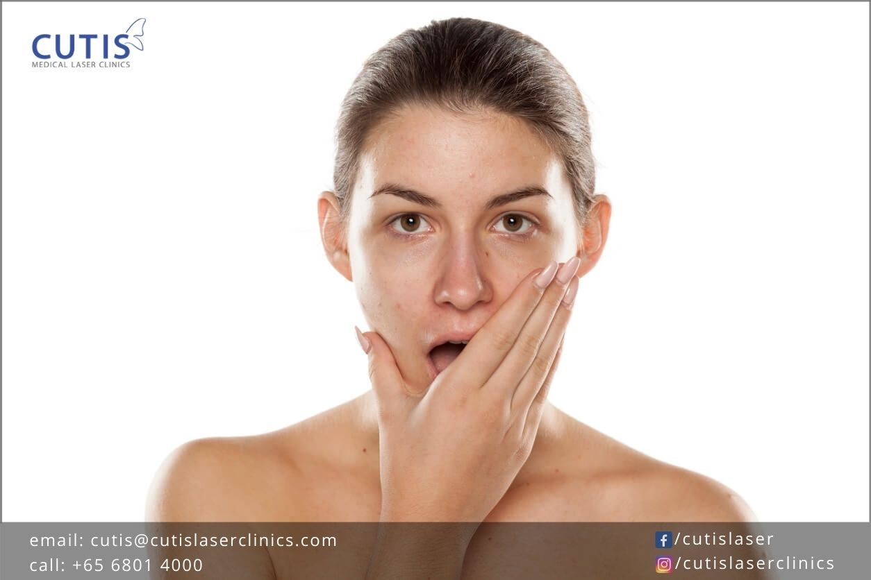 Chemical-Peel-at-Home