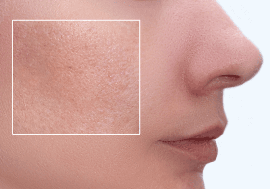 Skin Quality