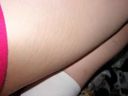 stretch-marks-cutis