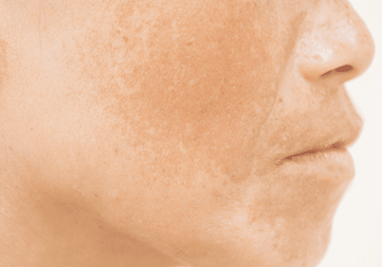 Medical Pigmentation Treatments