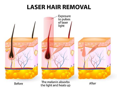 Hair Removal