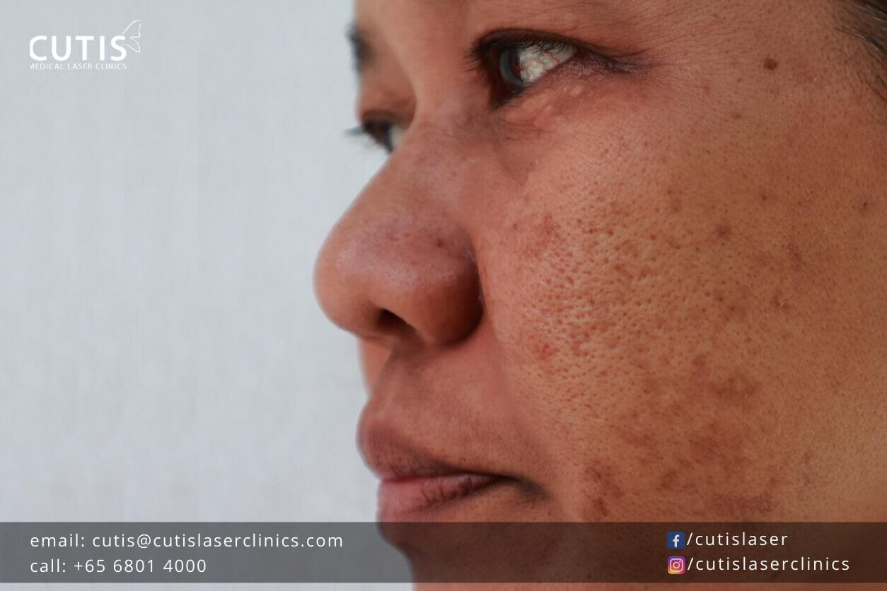 5-Myths-About-Pigmentation 5-Myths-About-Pigmentation
