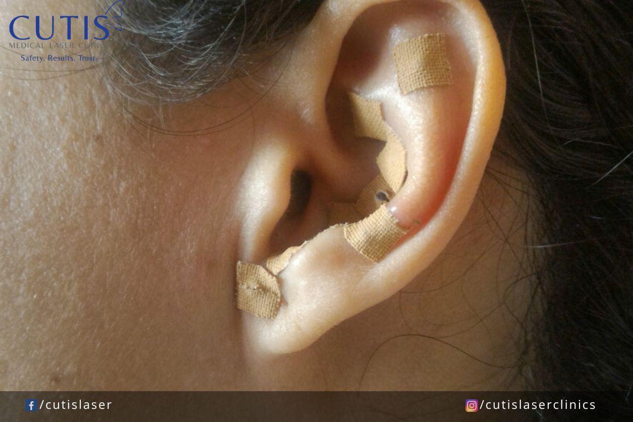 What is Ear Seeding & Why are Influencers Using it for Facial Contouring