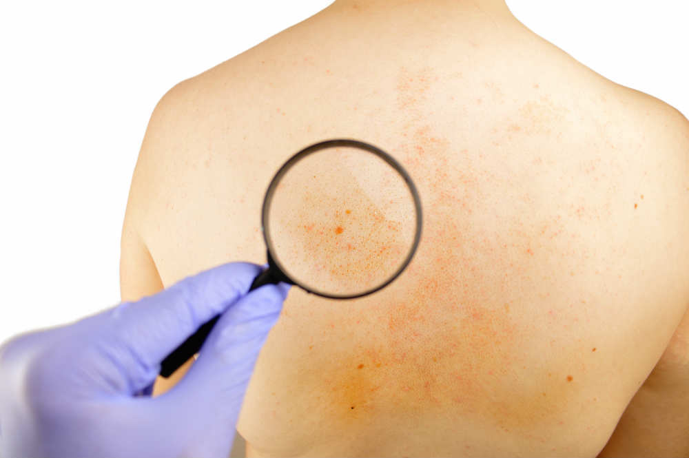 Back Acne Treatments