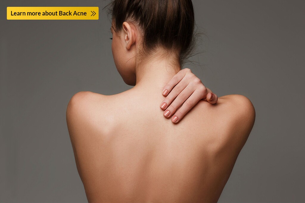 back acne