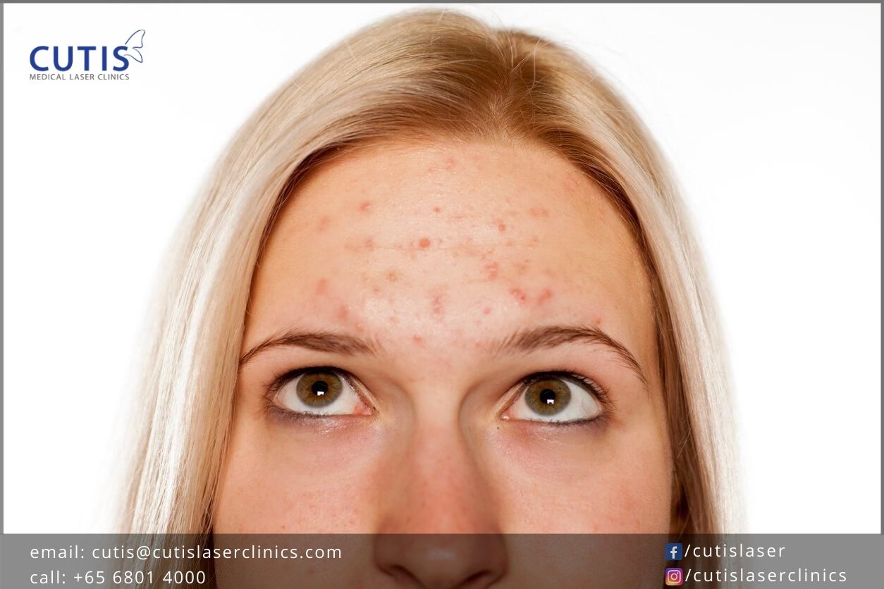 What’s-the-Deal-with-Forehead-Acne What’s-the-Deal-with-Forehead-Acne
