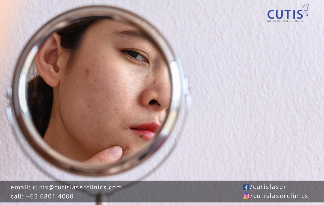 5-Common-Questions-About-Acne-Scars-Answered 5-Common-Questions-About-Acne-Scars-Answered