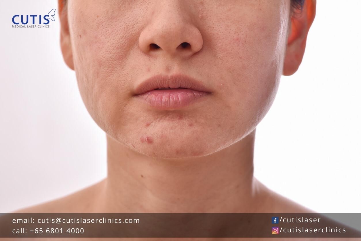 Got-Oily-or-Acne-Prone-Skin Got-Oily-or-Acne-Prone-Skin