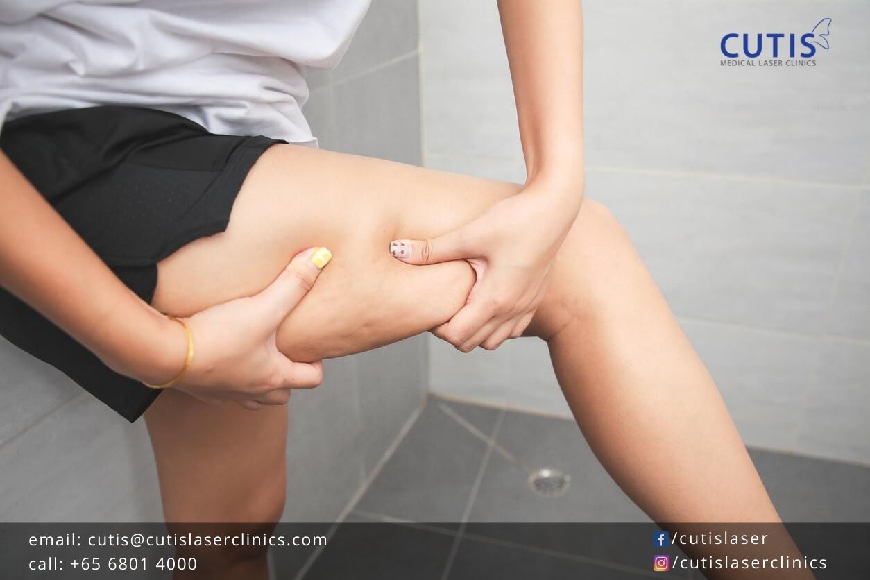 Why-Dieting-Isn’t-Enough-to-Fight-Cellulite Why-Dieting-Isn’t-Enough-to-Fight-Cellulite