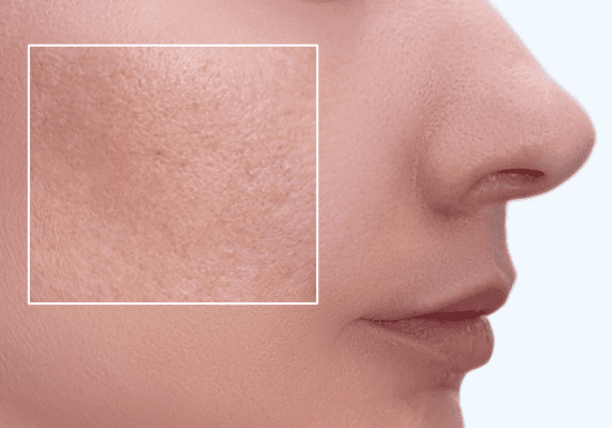 Skin Quality