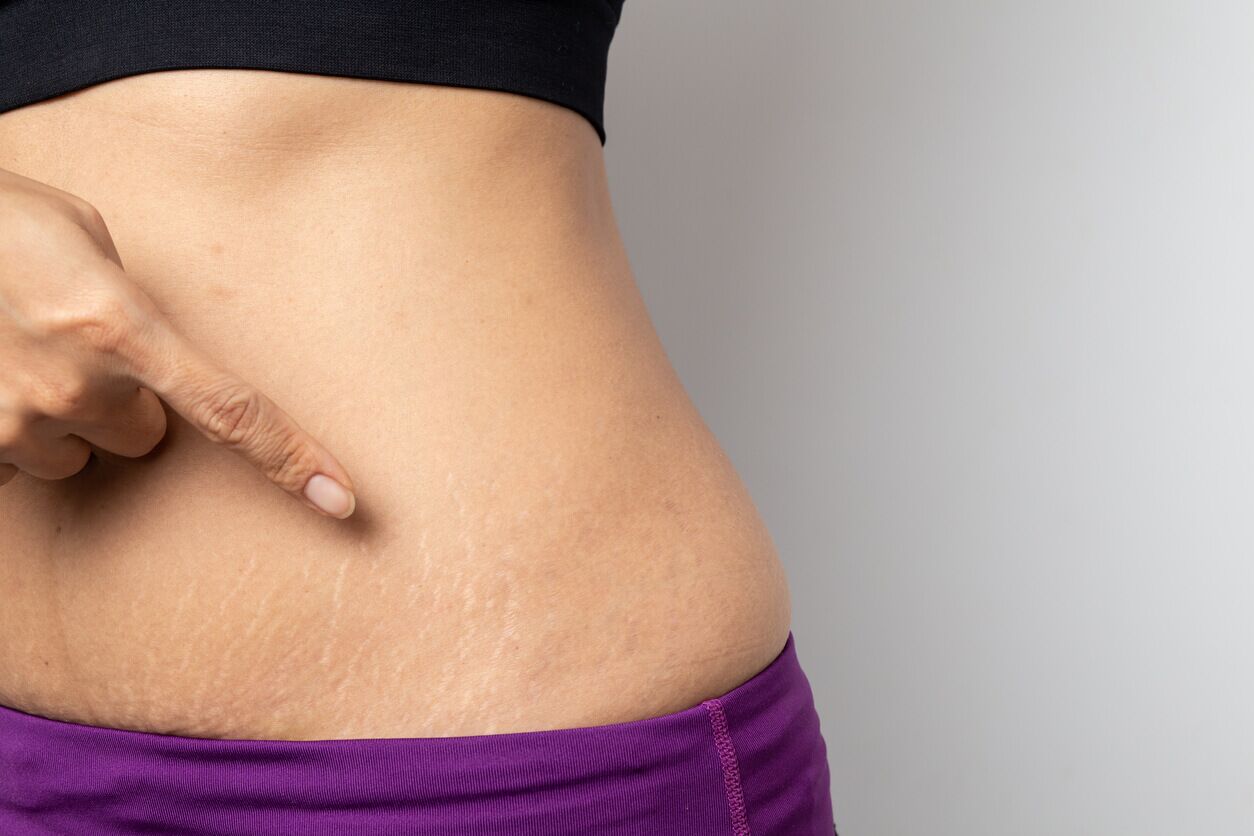 Stretch Marks Go Away After Pregnancy