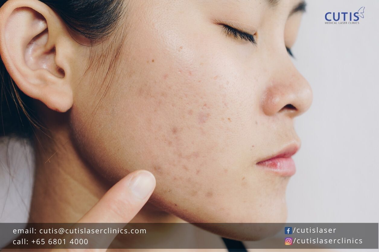 Get-Rid-of-Blackheads-Cutis-Laser-Clinics