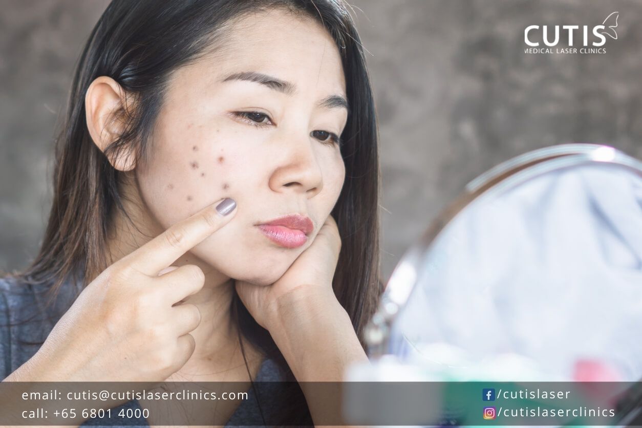 Why-Are-Your-Dark-Spots-Not-Going-Away Why-Are-Your-Dark-Spots-Not-Going-Away