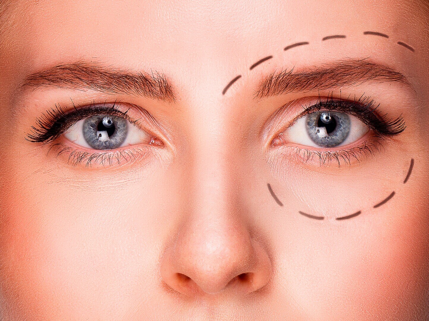 Bothered-by-Droopy-Eyelids Bothered-by-Droopy-Eyelids
