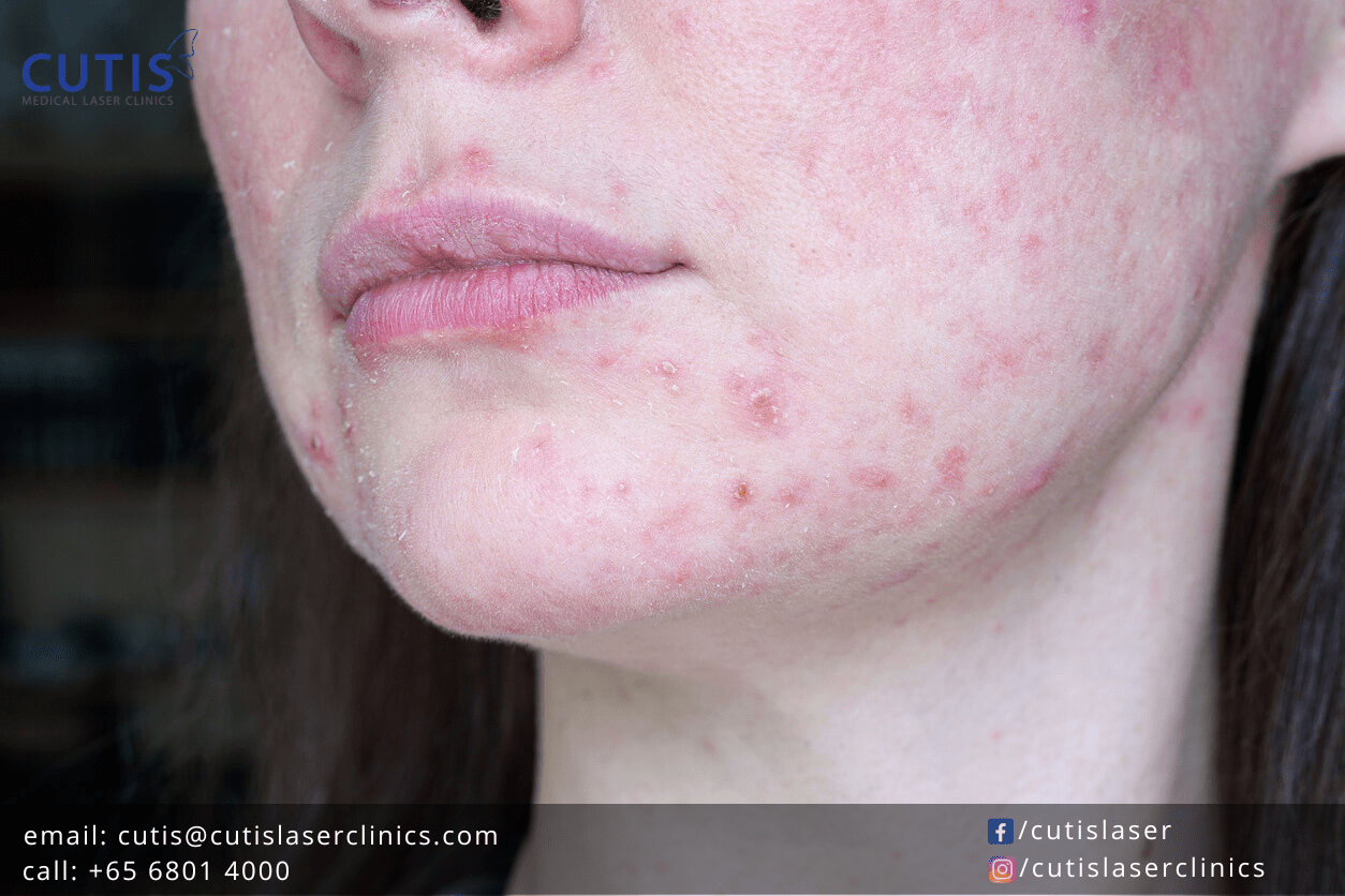 glp 1 rosacea Treatments for Managing Rosacea Symptoms