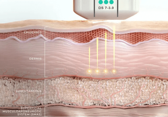 【極美品】Non-Surgical Skin Tightening and Li Ultraformer MPT® Skin Tightening Brisbane | Elysium Skin Centre