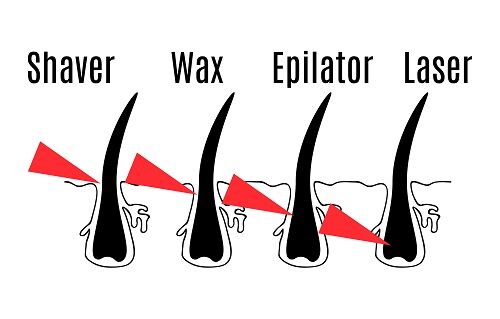 Hair Removal Options 