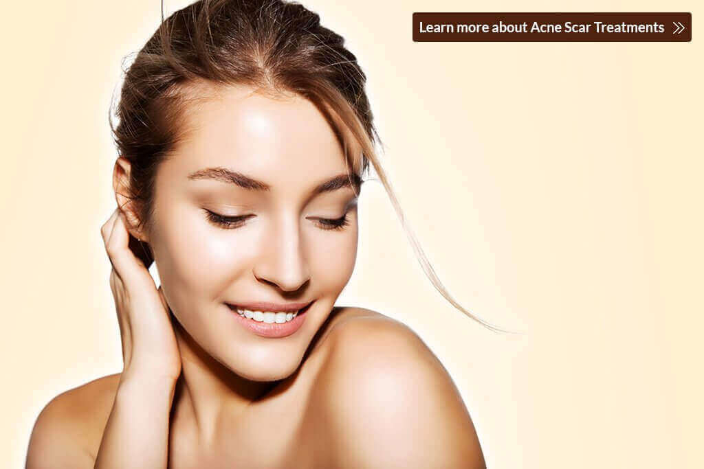 5 Effective Acne Scar Treatments