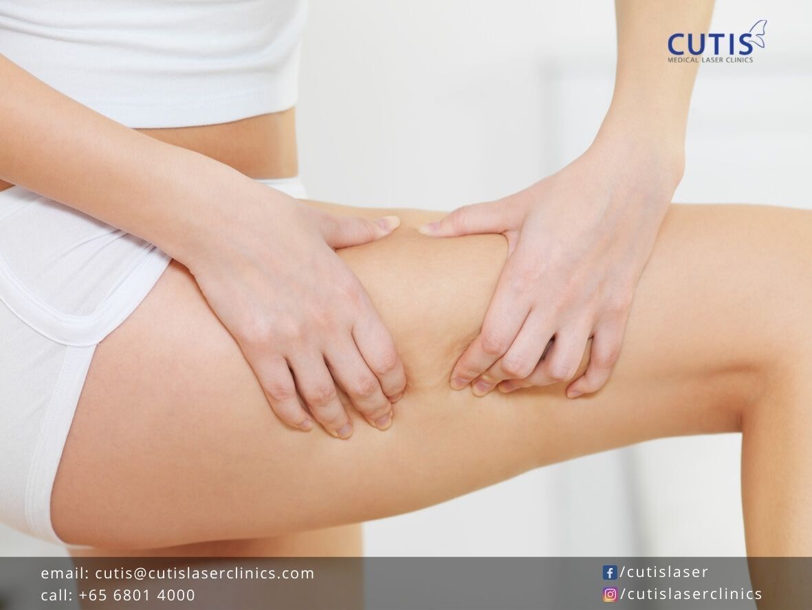Reduce-Cellulite-with-Exilis-Ultra-360-and-Acoustic-Shockwave-Therapy