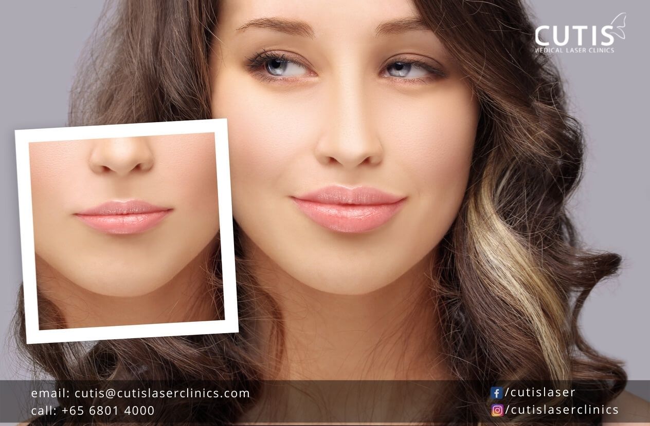 Caring-for-Your-Lips-After-Dermal-Fillers