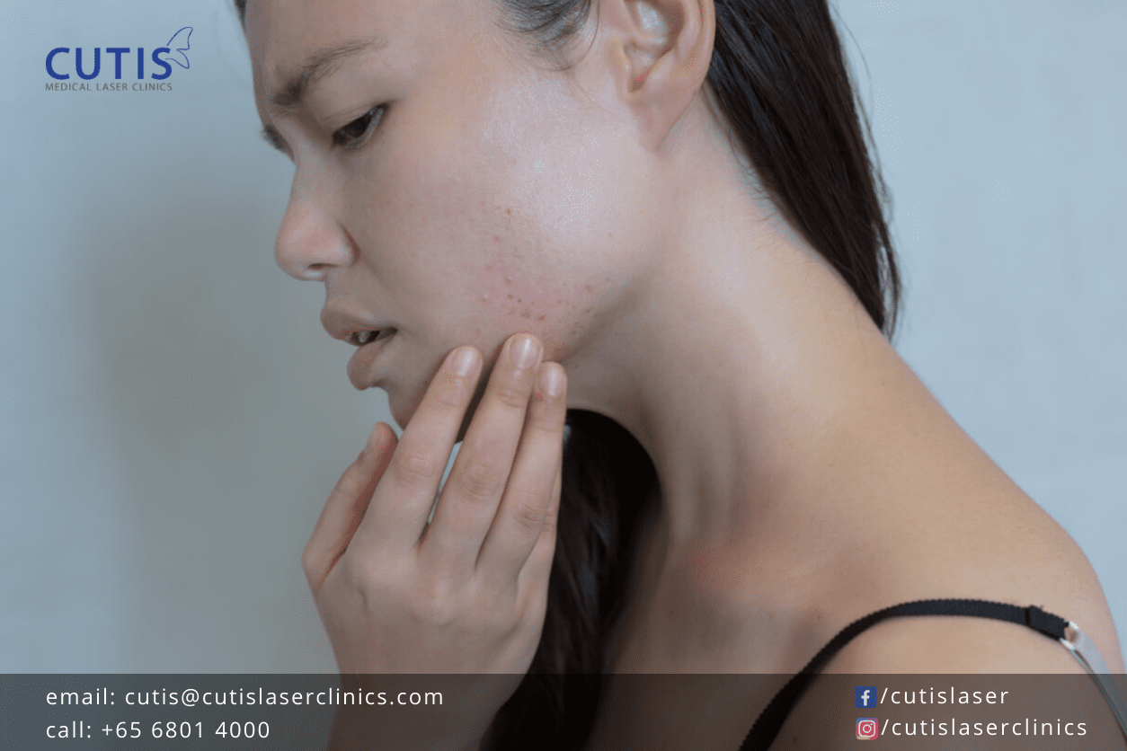 What Causes Sudden Breakouts?