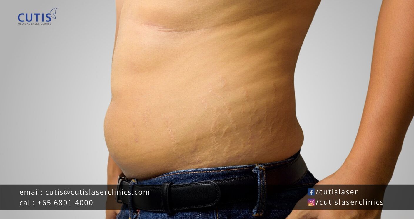 How To Get Rid Of Stretch Marks