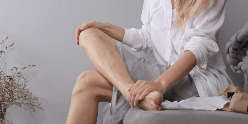 Vein Removal