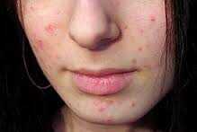 Acne Treatment
