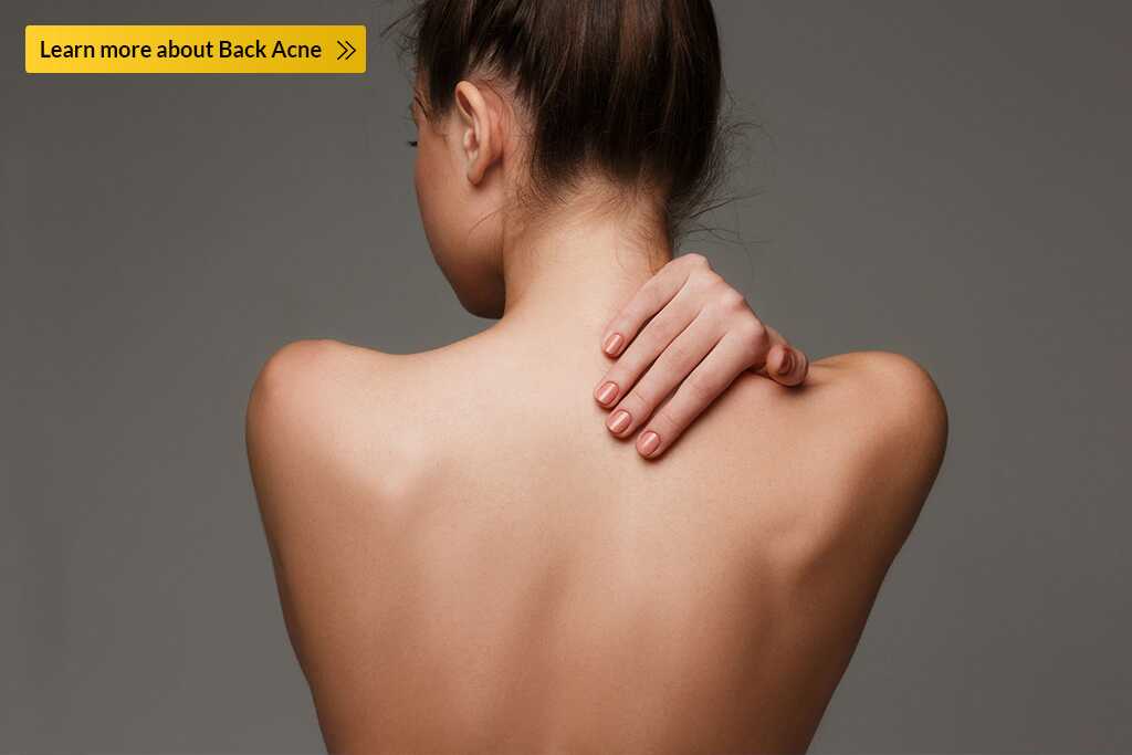 back acne