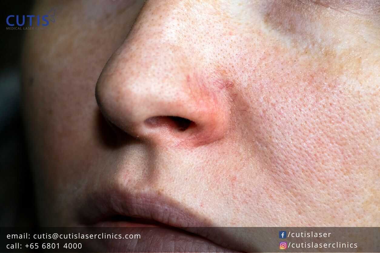 Do You Have Spider Veins on Your Face